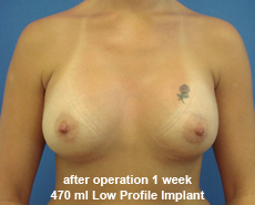 plastic-surgery-breast-augmentation
